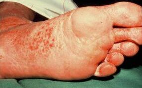 Hongos y úlceras en los pies