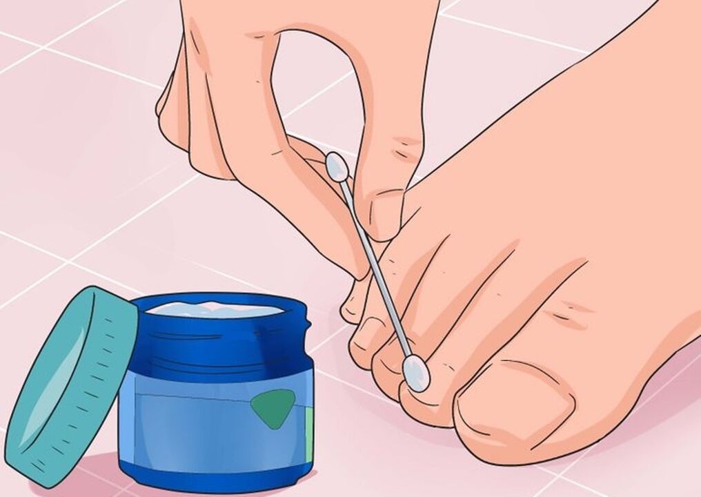 Hongos curativos de uñas