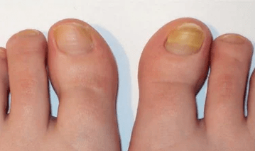 La etapa inicial del hongo de las uñas