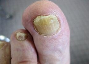 Causas de hongos que aparecen en las uñas