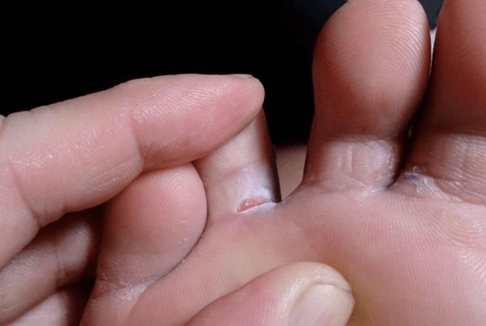 Aparición de formaciones de burbujas en los pies