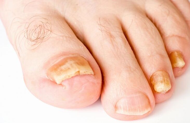 Uñas de los pies amarillas debido a hongos.