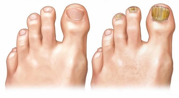 Hongos sanos en uñas de manos y pies