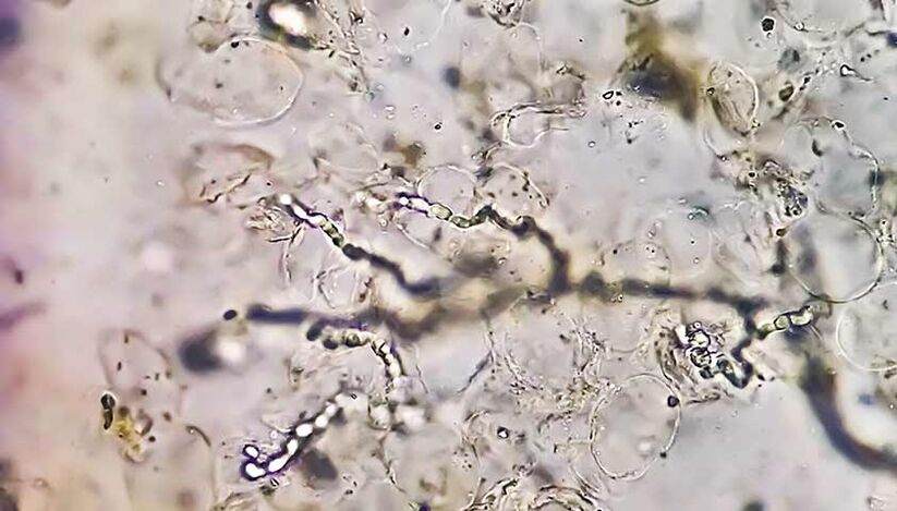 Hongos bajo el microscopio los culpables de las enfermedades fúngicas de los pies